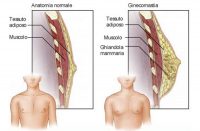 ginecomastia anatomia